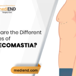 What are the Different Grades of Gynecomastia?