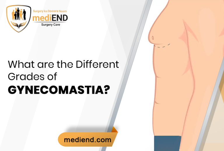 What are the Different Grades of Gynecomastia?