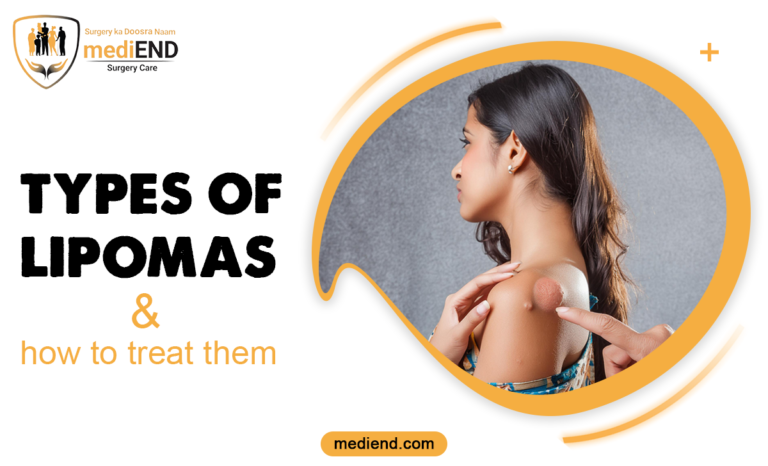 Types of lipomas and how to treat them