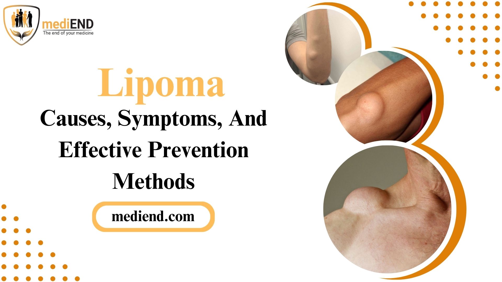 Lipoma Causes, Symptoms, And Effective Prevention Methods