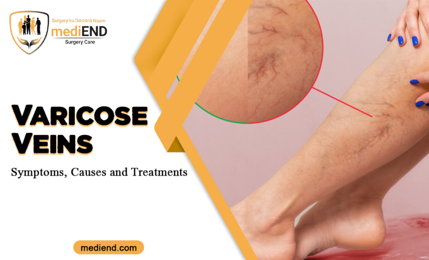 Varicose Veins Symptoms, Causes and Treatments