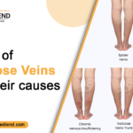 Types of Varicose Veins and Their Causes