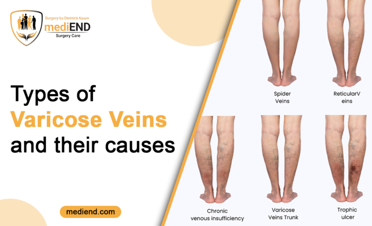 Types of Varicose Veins and Their Causes