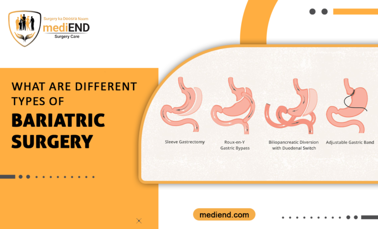 What Are Different Types Of Bariatric Surgery