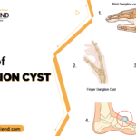 Types of Ganglion Cyst