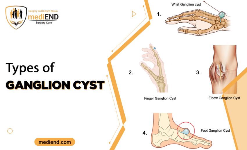 Types of Ganglion Cyst