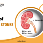 Types of Kidney Stones