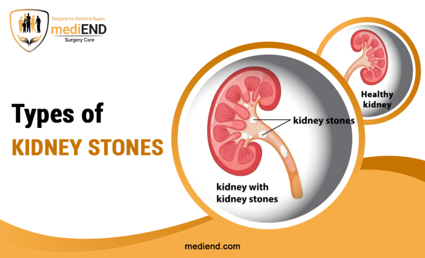 Types of Kidney Stones