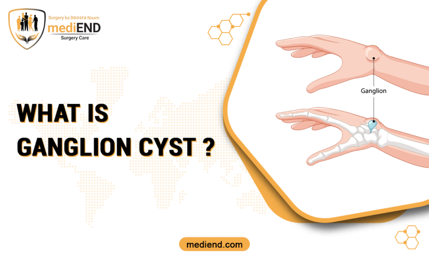 What is Ganglion Cyst?